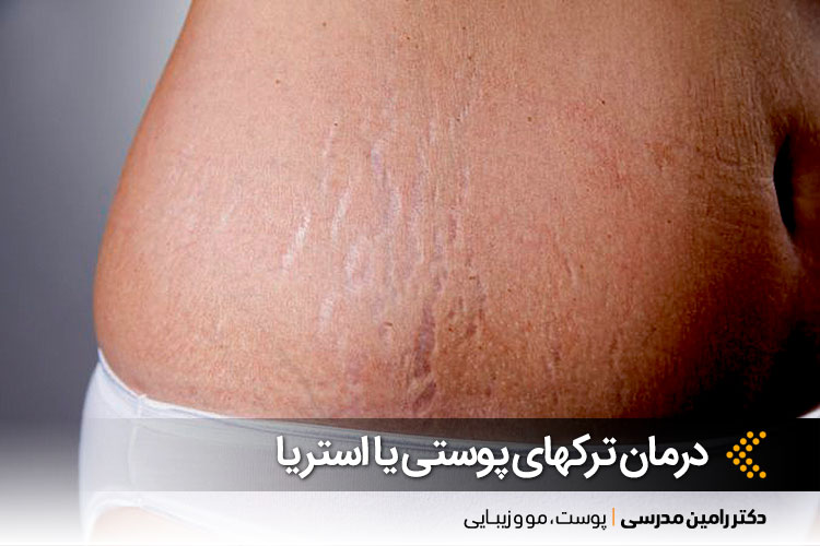 درمان استرچ مارک در اصفهان